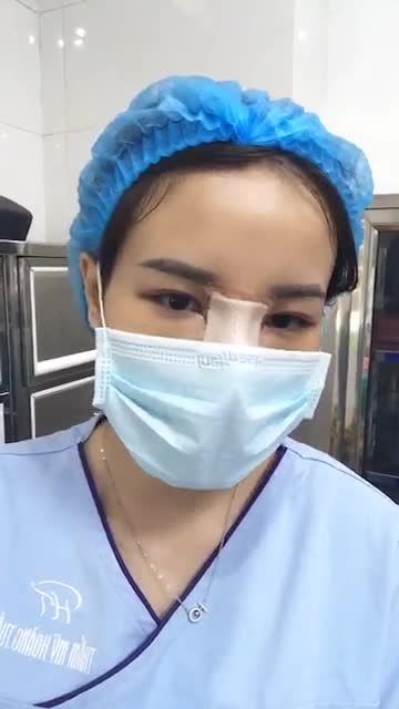 Nhấn mí 5 điểm Dr Hoàng Tuấn giúp bạn gái trẻ có nếp mí mới tròn xinh.