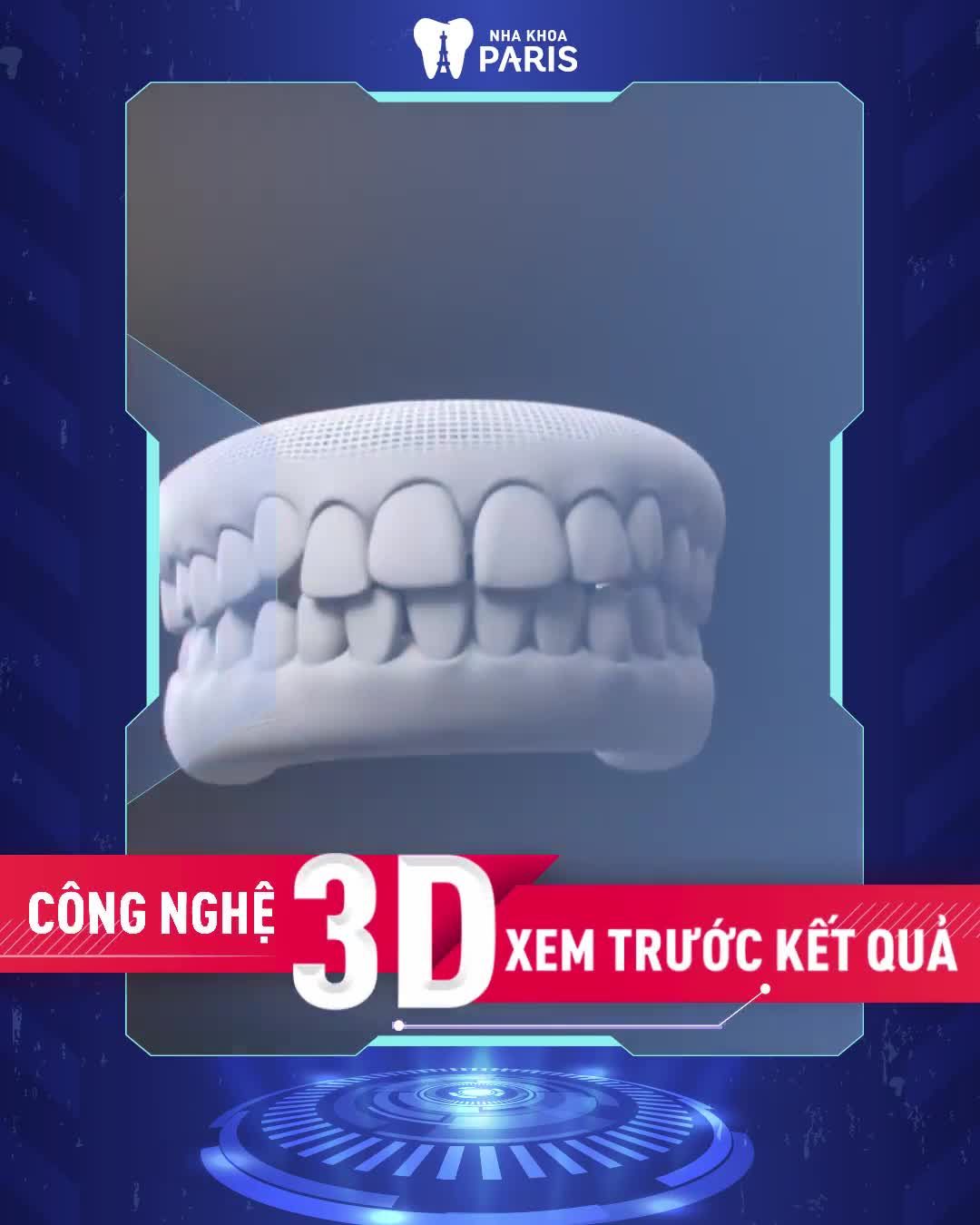 NIỀNG RĂNG TRONG SUỐT GIÁ CỰC SỐC - OFF 25%