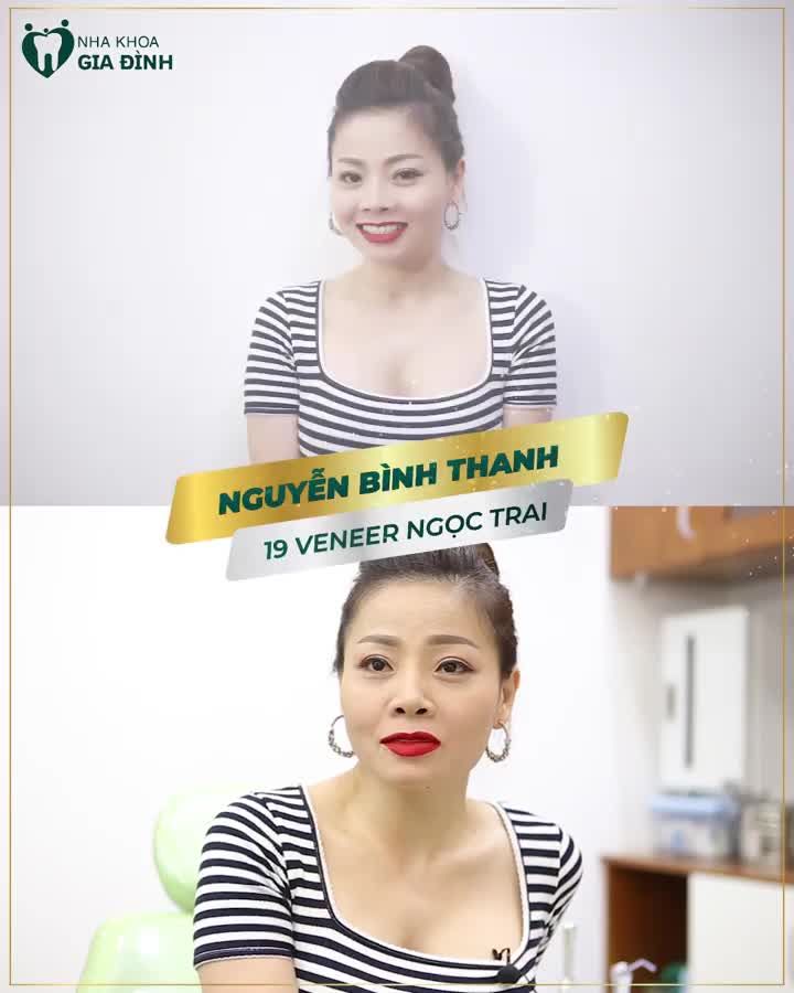 THOẢ SỨC ĂN NHAI – CƯỜI TƯƠI THOẢI MÁI VỚI DÁN SỨ VENEER