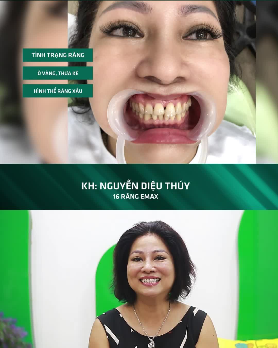 THẨM MỸ RĂNG TRẢI NGHIỆM TUYỆT VỜI VỚI RĂNG SỨ E.MAX
