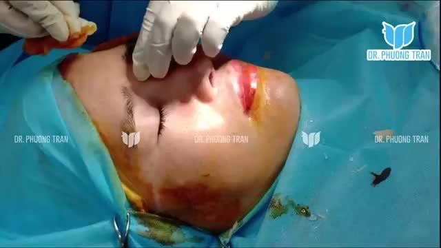 Ca nâng mũi cấu trúc vừa mới hoàn thành