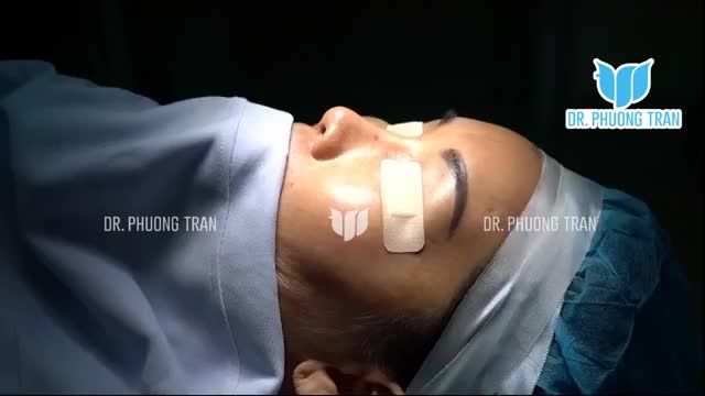 CẬN CẢNH QUÁ TRÌNH NÂNG MŨI SỤN SƯỜN KHẮC PHỤC MŨI NGẮN, LUNG LAY VÀ LỆCH