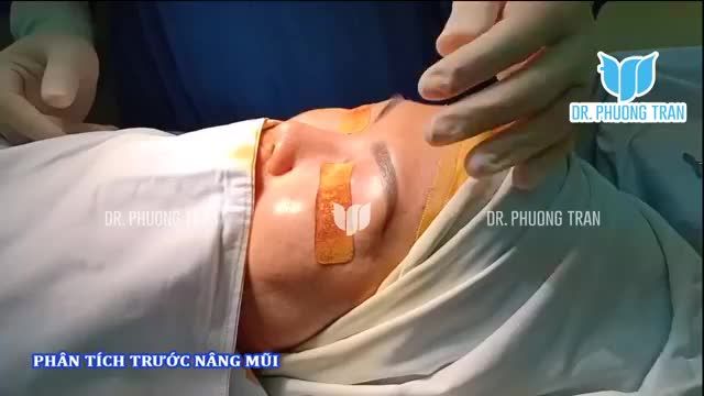 CẬN CẢNH QUY TRÌNH NÂNG MŨI CẤU TRÚC SỤN SƯỜN