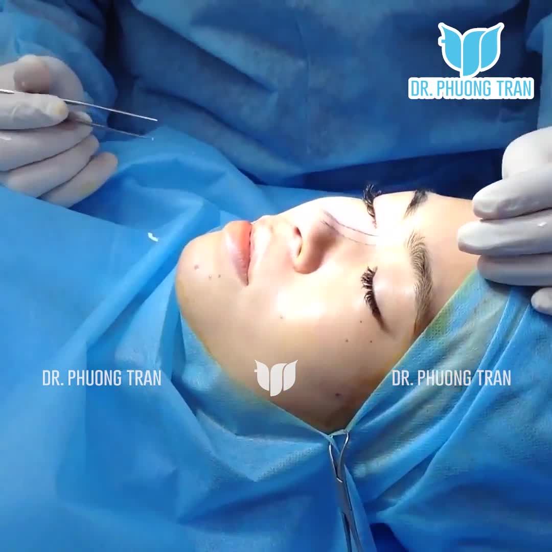 CẬN CẢNH TOÀN BỘ QUÁ TRÌNH NÂNG MŨI ĐẶT SỐNG SURGIFORM KHẮC PHỤC MŨI GÃY