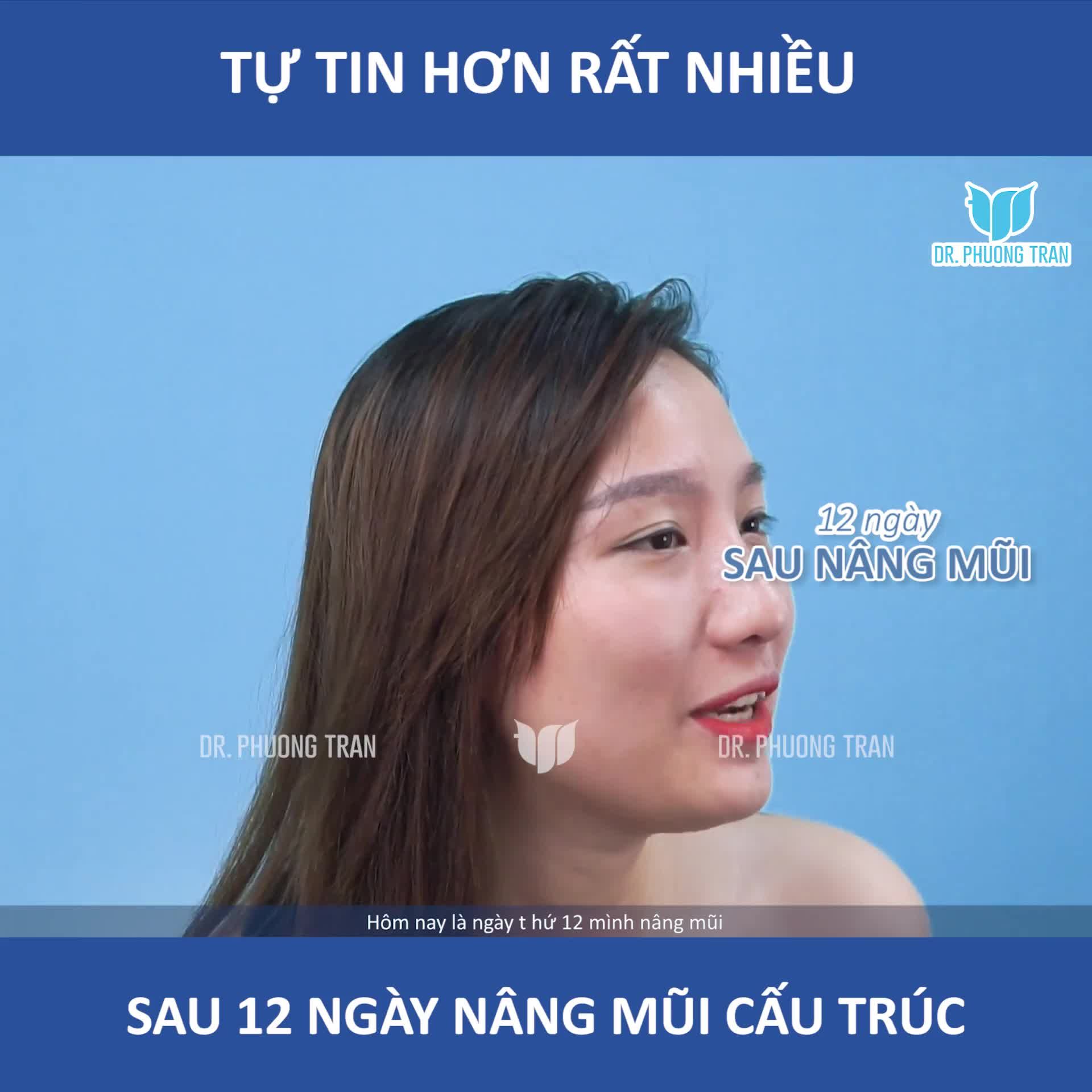 CÂU CHUYỆN NÂNG MŨI]: KHÁCH HÀNG XUÂN MAI