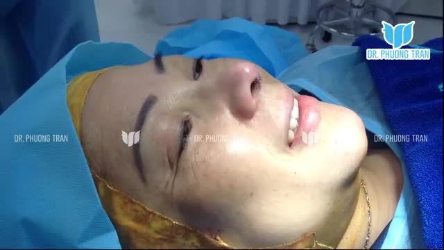 CỨ NGHĨ NÂNG MŨI SẼ ĐAU VÀ SƯNG DỮ LẮM