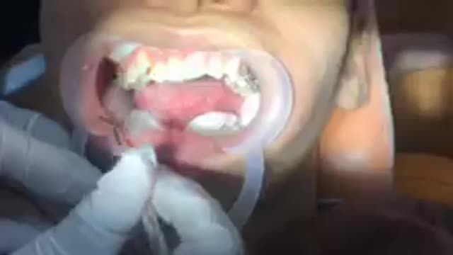 Gắn mắc cài cho khách hàng răng KHẤP KHỂNH - CẮN ĐỐI ĐẦU