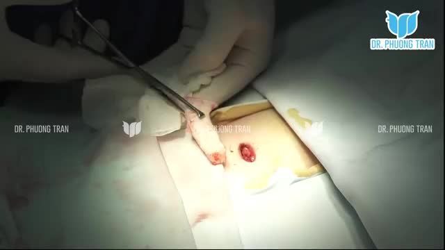 LẤY SỤN SƯỜN CÓ NGUY HIỂM KHÔNG?