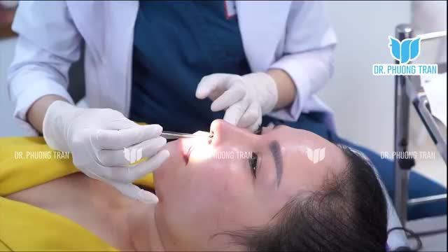 MŨI CẤU TRÚC SỬA LẠI: LÀM XONG ƯNG QUÁ ƯNG