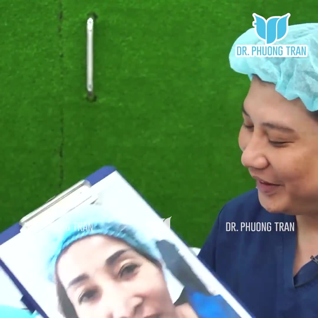 MŨI ĐÃ TỪNG NÂNG 2 LẦN TRƯỚC, ĐẦU MŨI NHỌN, QUÁ DÀI VÀ CỤP THÌ NÊN SỬA LẠI NHƯ THẾ NÀO?