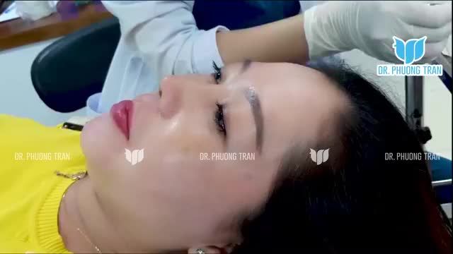 NÂNG MŨI CẤU TRÚC DÁNG TỰ NHIÊN