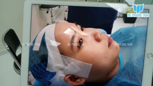 Nâng mũi cấu trúc Surgiform: Cận cảnh sự thay đổi trước và ngay sau phẫu thuật