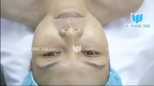 Nâng mũi sụn sườn cho khách hàng mũi hỏng