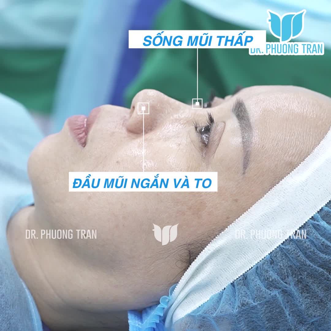 SẼ THẾ NÀO KHI LẦN ĐẦU TIÊN BẠN ĐƯỢC NHÌN THẤY DÁNG MŨI MỚI???