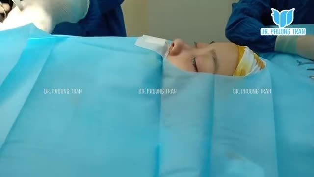 Trực tiếp ca nâng mũi sụn sườn toàn phần