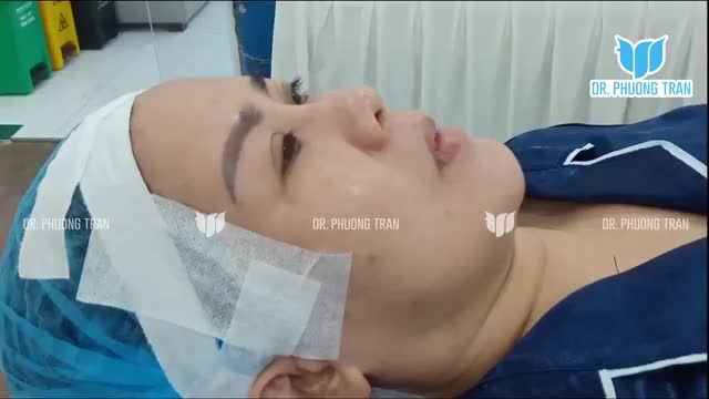TRƯỚC NÂNG MŨI, BẠN LO LẮNG NHẤT LÀ ĐIỀU GÌ?