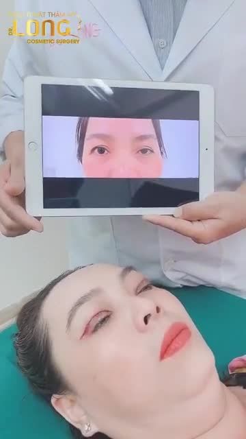 1 ca mắt khó. Mắt bị liệt cơ, 2 mí không đều nhau được chính tay Bác sĩ Long thực hiện Cắt Mí Plasma và kéo cơ nâng mi để tạo mắt 2 mí tự nhiên.
