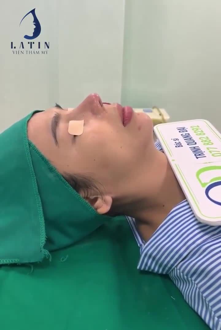 COMBO ĐỘN CẰM US PROSIL + MŨI TÁI CẤU TRÚC SỬA LẠI, TRỤ TNR MESH, SÓNG SUGIFORM