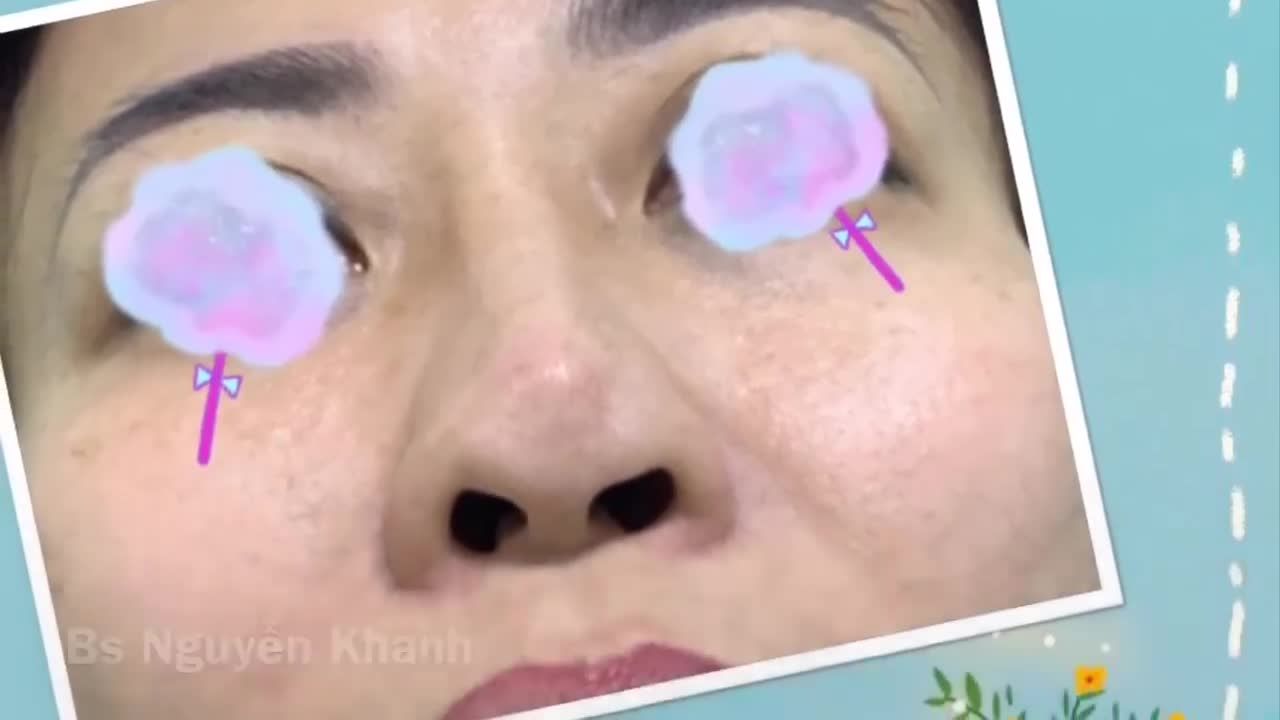 Hôm qua có bạn hỏi: sao e thấy mũi cấu trúc lúc nào cũng thon gọn, thanh mảnh hơn, độ lượn (võng) cũng mềm mại hơn mũi lót sụn?