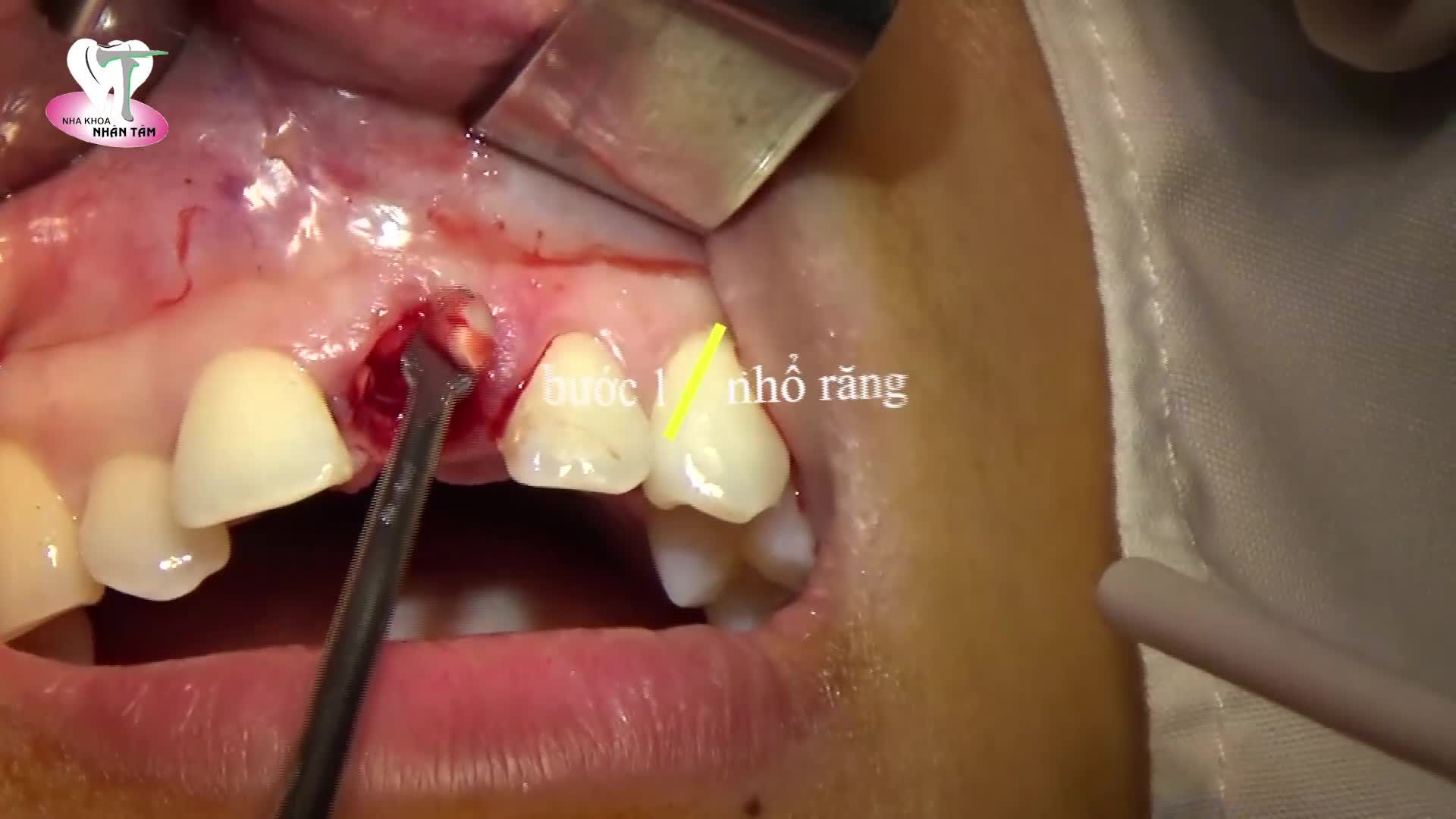 Khách hàng T.N, 26 tuổi, bị gãy răng R21 do tai nạn