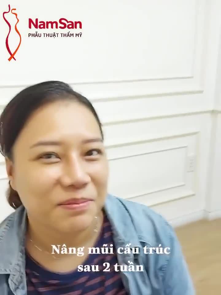 Khách hàng tái khám sau 2 tuần nâng mũi cẫu trúc. Kết quả dáng mũi cao mà vẫn tự nhiên nhìn như thật đó là điều khách ưng nhất