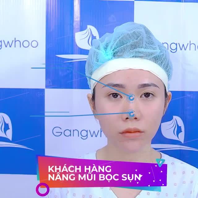 MŨI CAO TỰ NHIÊN - NÀNG THÊM XINH XẮN