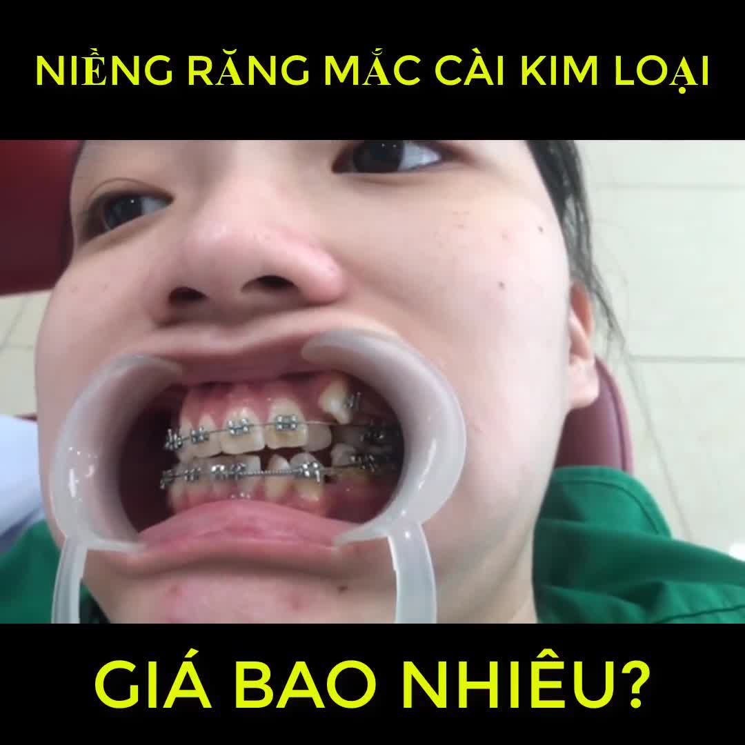 NIỀNG RĂNG KIM LOẠI GIÁ BAO NHIÊU?