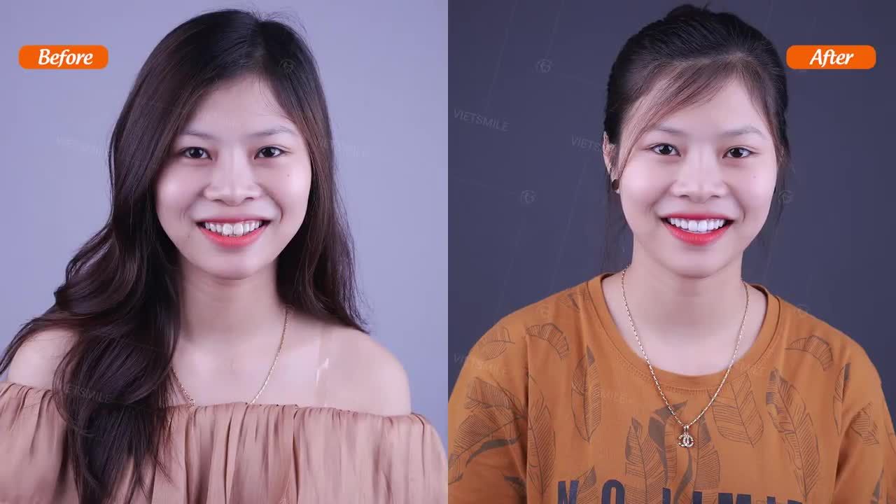 Răng nhiễm màu, khấp khểnh làm răng sứ như thế nào để vừa thẩm mỹ lại bảo tồn răng gốc tối đa.