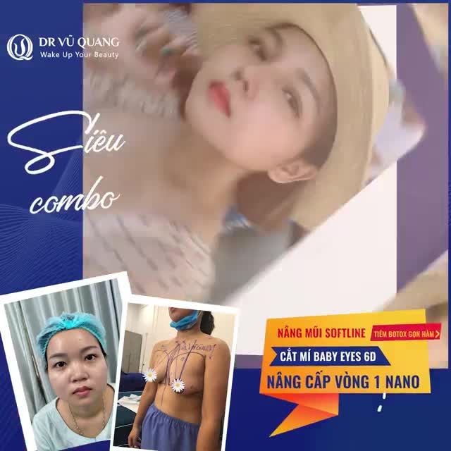 SIÊU COMBO NÂNG MŨI SOFTLINE + CẮT MÍ BABY EYES 6D + NÂNG NGỰC -ƯU ĐÃI CỰC SỐC