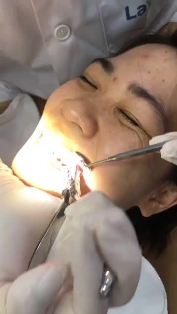 Tháo mắc cài chắc là thời điểm mà tất cả các bạn chỉnh nha bằng mắc cài mong chờ nhất