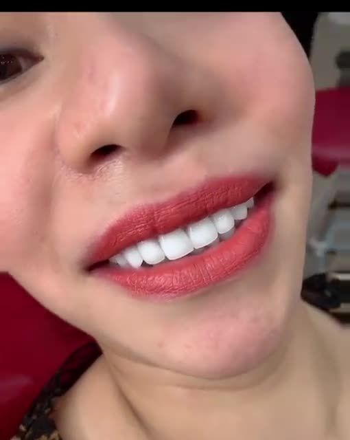 Trả lại Nụ Cười Tự Tin và Tỏa Sáng cho chị Hạnh