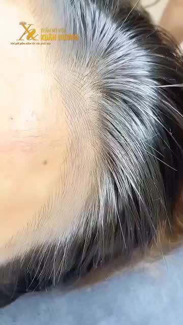 TRÁN CHỮ M, THƯA H.ÓI DO TÓC RỤNG - GIẢI PHÁP NÀO HIỆU QUẢ NGAY TỨC THÌ, ĐẸP NHƯ TÓC THẬT?