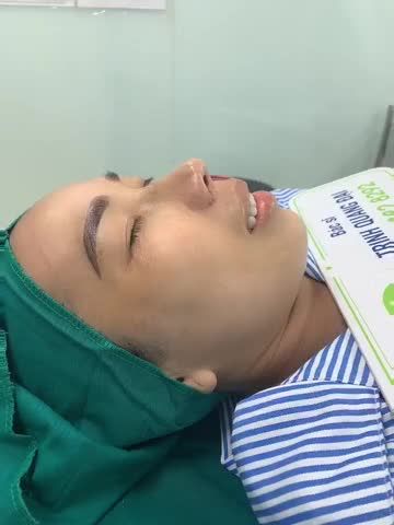CA MŨI BÁN CẤU TRÚC CHO CHỊ KHÁCH TỪ AN GIANG