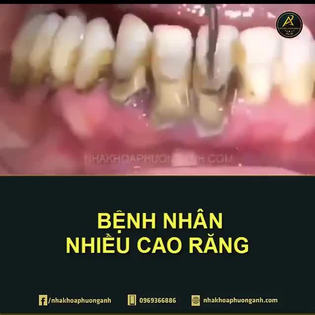 Cao răng bám vào chân răng như hồi bé mình ăn bánh khảo vậy