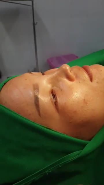 NÂNG MŨI BÁN CẤU TRÚC SỤN ĐA LỚP TAI SAU 45PHÚT