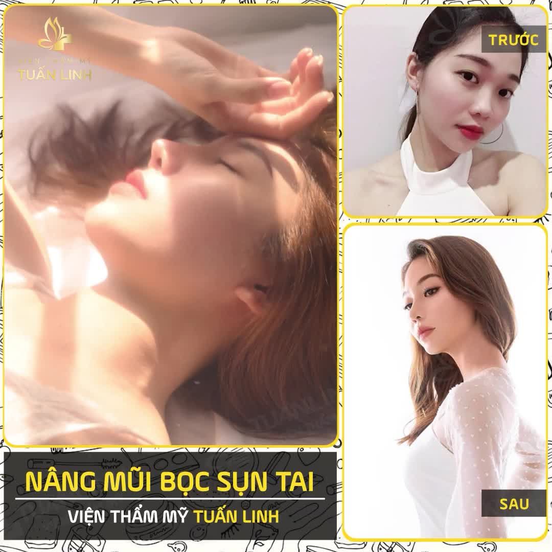 NÂNG MŨI BỌC SỤN LÀ GÌ