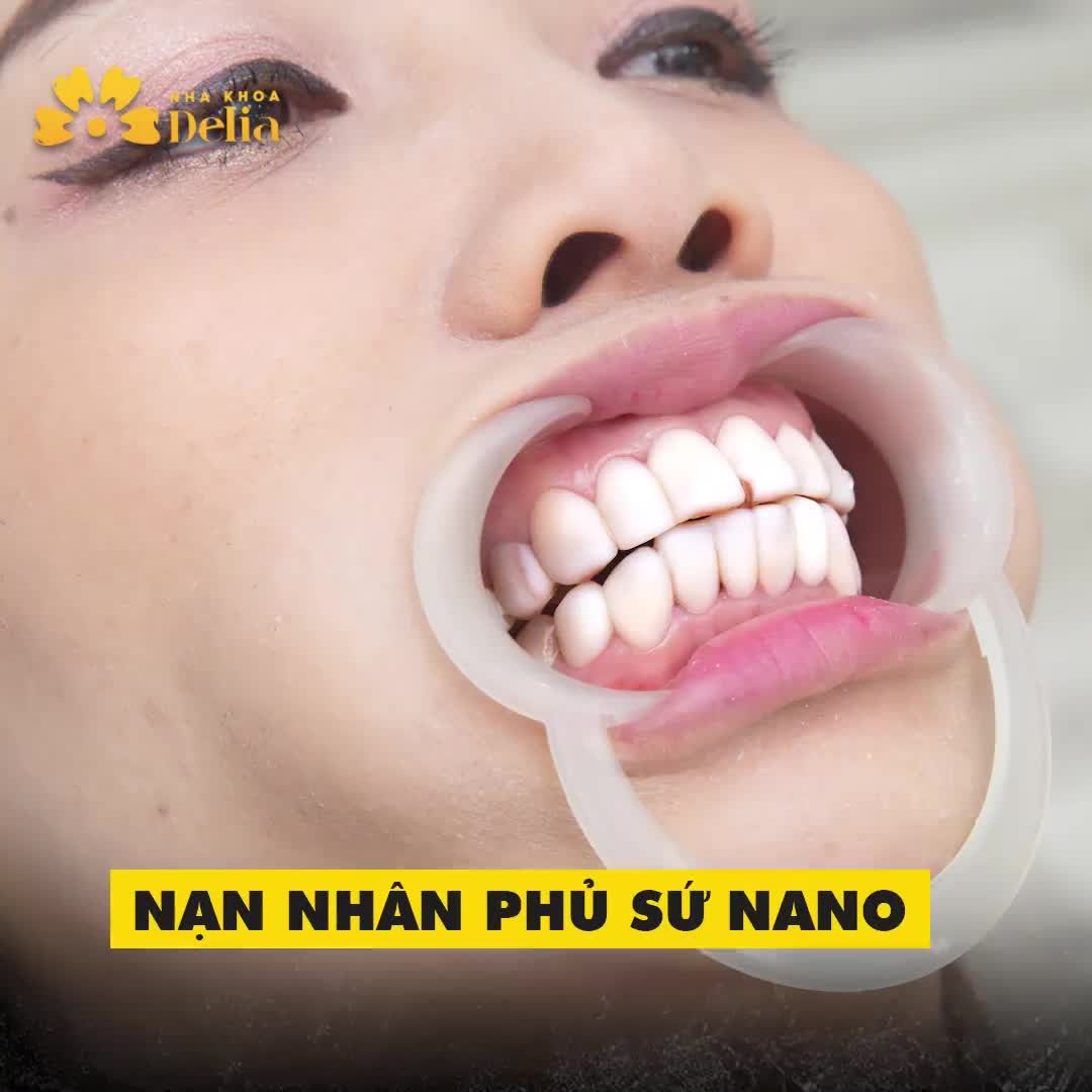 PHỦ SỨ NANO: HÔI MIỆNG, VIÊM LỢI, HƯ HỎNG RĂNG GỐC