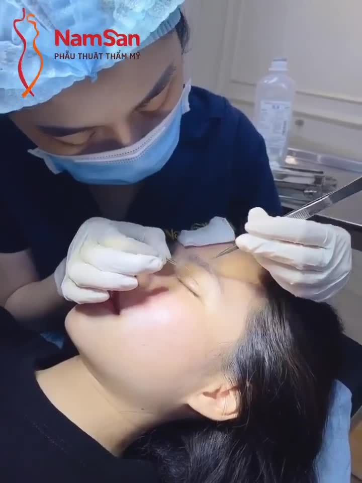 Sau 5 ngày khách đến cắt chỉ mà nếp mí đã nét xuất sắc luôn rồi.