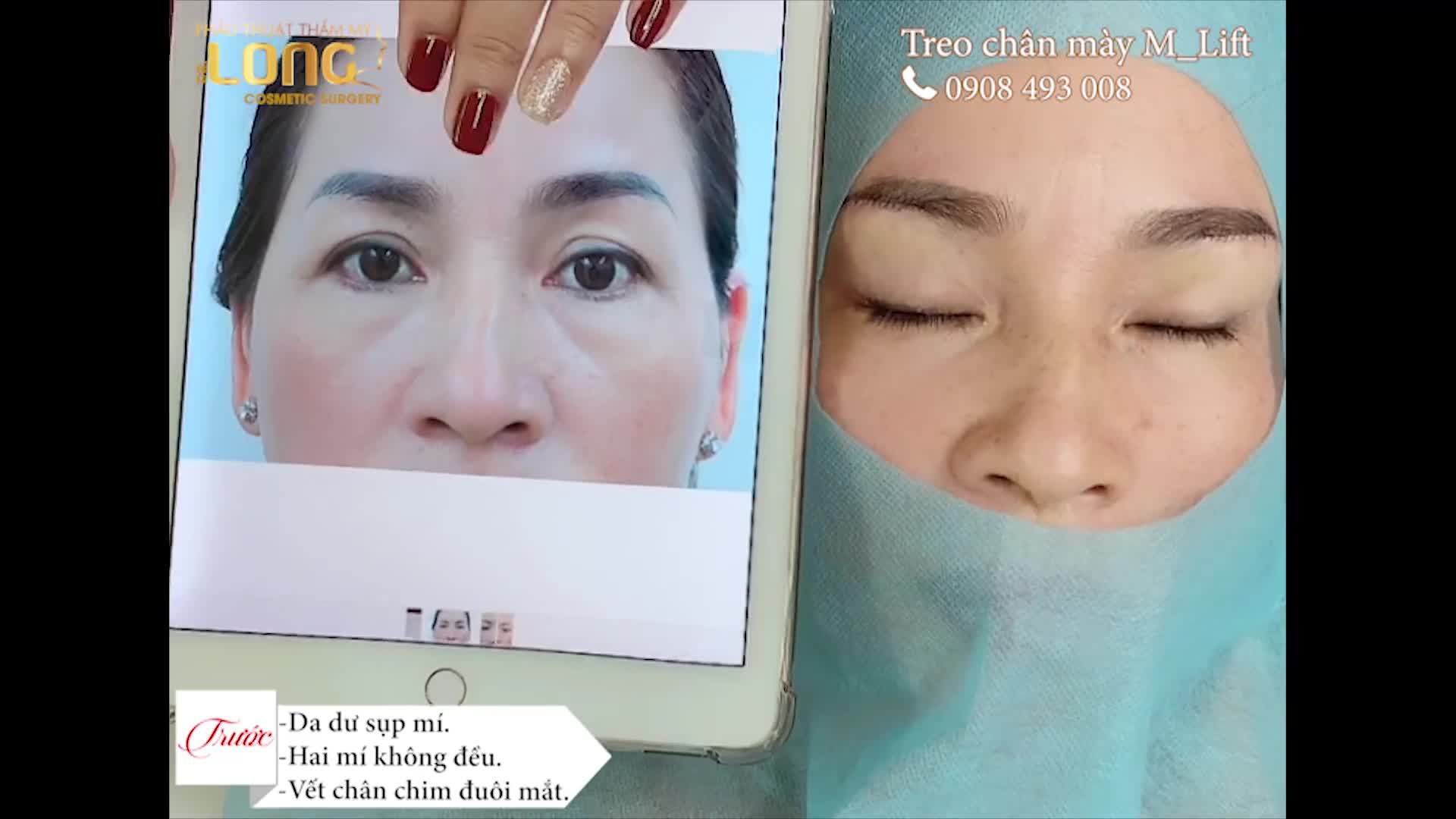 ️Treo Chân Mày M Lift - Nâng Cơ Trẻ Hoá Đôi Mắt