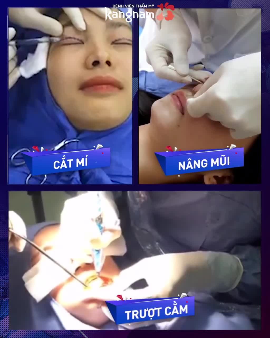 Combo MẮT + MŨI + CẰM chị khách làm sau 1 tháng nè