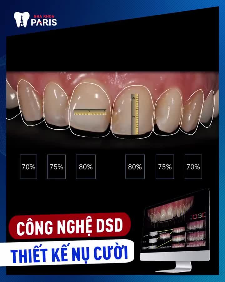 2 NGÀY BỌC SỨ HẾT Ố VÀNG, NHIỄM MÀU, THƯA MẺ