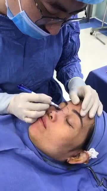 Phân tích case kh Đặc biệt: Nâng mũi cấu trúc 4D+ bóc tách filler cùng bác sĩ Kangnam