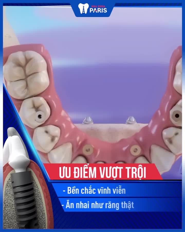 KHÔI PHỤC CẢ HÀM RĂNG MẤT VỚI IMPLANT ALL ON