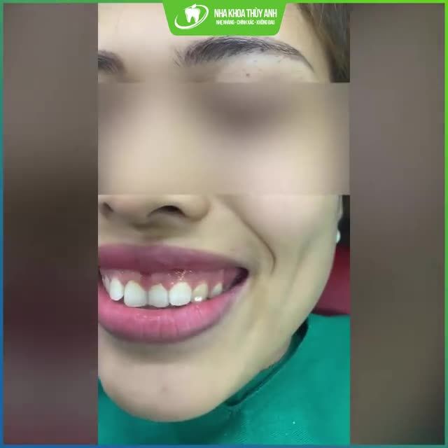 Hình ảnh thực tế ngay sau điều trị cười hở lợi tại Nha Khoa Thùy Anh