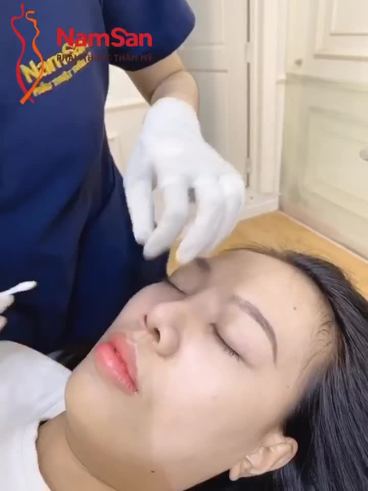 Mới 10 ngày thôi mà mũi khách hàng đã đẹp lên hình rất ăn ảnh.