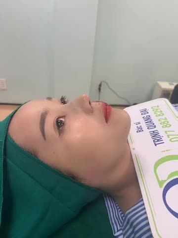 MŨI BÁN CẤU TRÚC THU NỀN XƯƠNG CHO EM GÁI CÀ MAU