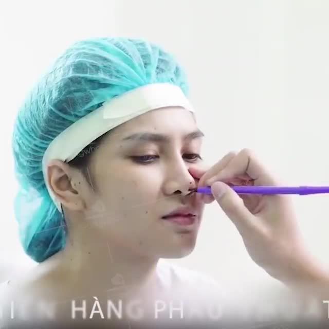 SỬA MŨI HỎNG LỆCH SÓNG - DÁNG MŨI NANOFORM 6D ĐẸP MÊ HỒN