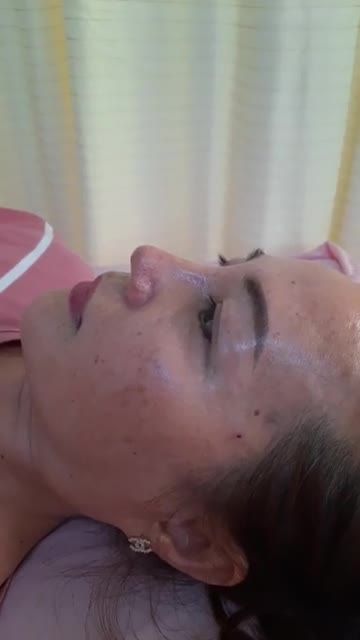 TÁI KHÁM NÂNG MŨI BÁN CẤU TRÚC SỤN TAI ĐA LỚP SAU 45 NGÀY