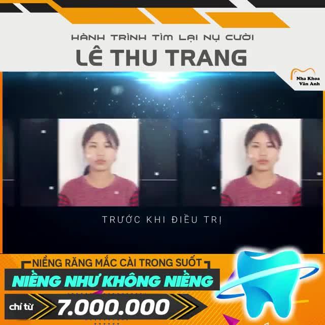 TRẢ GÓP CHỈ 1 TRIỆU MỖI THÁNG - NIỀNG RĂNG MẮC CÀI TRONG SUỐT - NIỀNG NHƯ KHÔNG NIỀNG ???