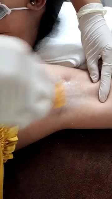 Triệt lông nách tận gốc sau 1 liệu trình điều trị với công nghệ Diode laser